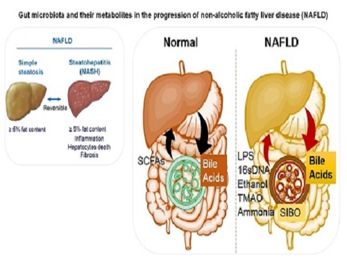 Gut microbiota and their metabolites in the progression of non-alcoholic fatty liver disease.