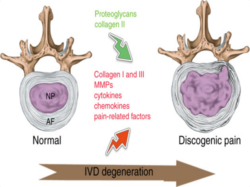 Painful intervertebral disc degeneration and inflammation: from laboratory evidence to clinical interventions